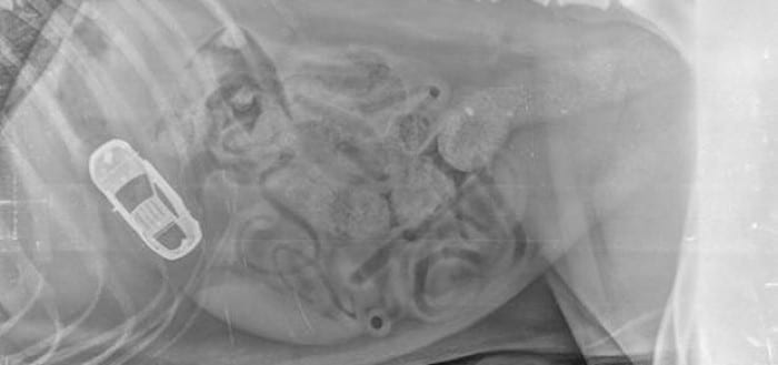 X-ray image showing the abdomen with a clear outline of a small toy car located within the gastrointestinal tract.