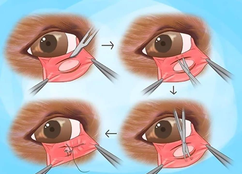 Illustrated steps of an eye surgery technique. The sequence shows needles and sutures adjusting tissue around the eye in four stages, indicating correction or reconstruction. The eye remains central in each image with arrows showing the process.